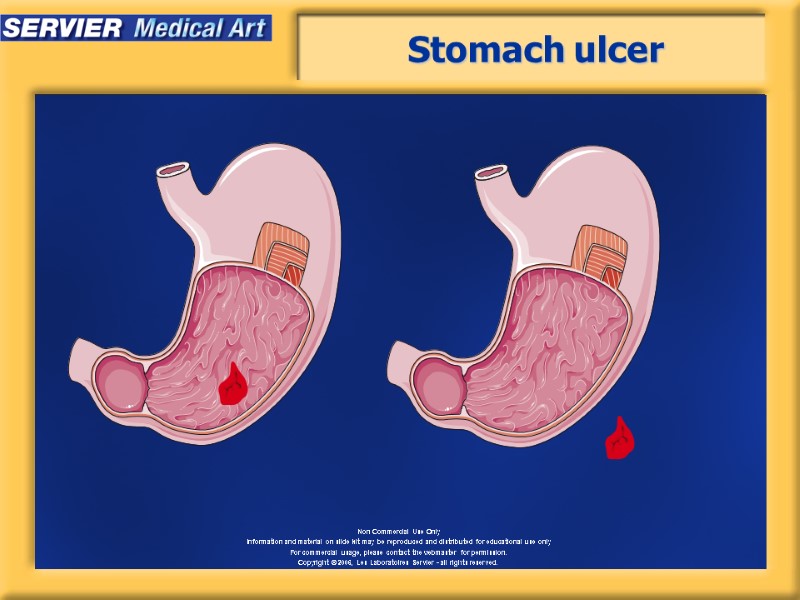 Stomach ulcer